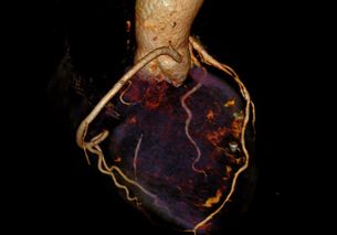 diag_vorderwandarterie01.jpg