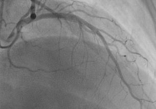 diag_vorderwandarterie04.jpg