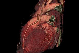 Bypassdarstellung_im_Herz-CT.jpg
