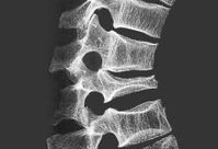csm_osteoporose_d22f167134.jpg